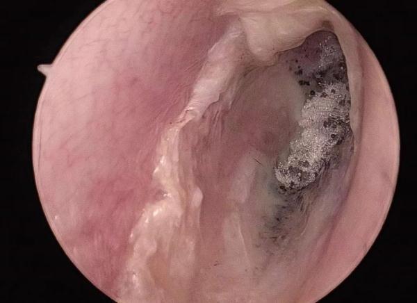 体验采耳后，男子耳内竟发霉了